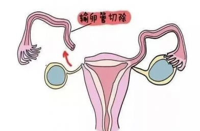 深圳慈铭博鳌国际医院三代试管婴儿，切除双侧输卵管还能做试管婴儿吗？