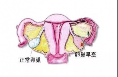 深圳备孕试管婴儿知识_为什么年轻女性也会卵巢早衰？如何防止早衰？